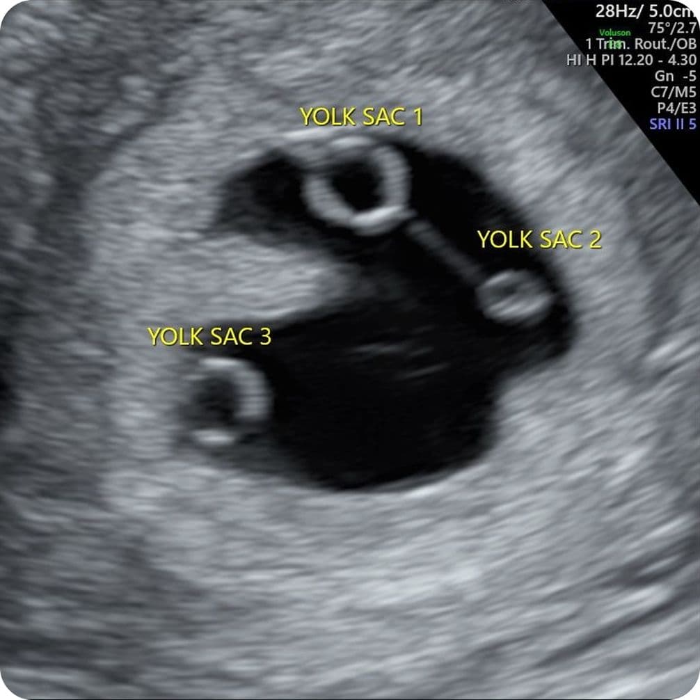 Ultrasound image showing three labeled yolk sacs in a gestational sac, indicating a multiple pregnancy.