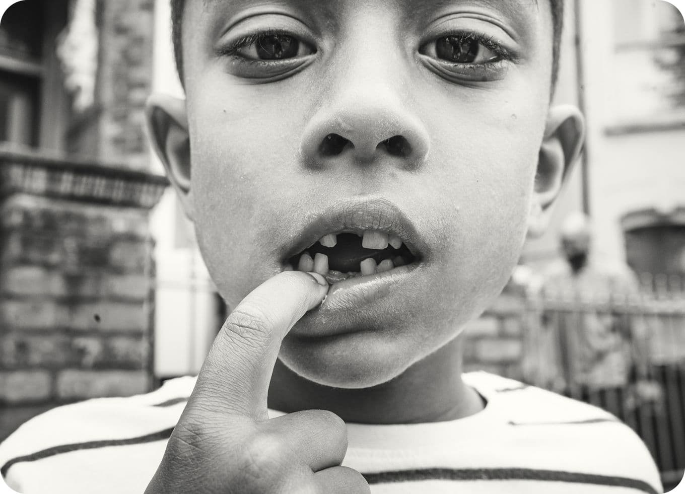 Close-up of a child pointing to a missing tooth, wearing a striped shirt. Background shows a blurred outdoor setting with a brick wall.